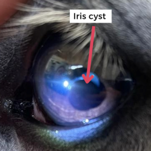 Iris cyst