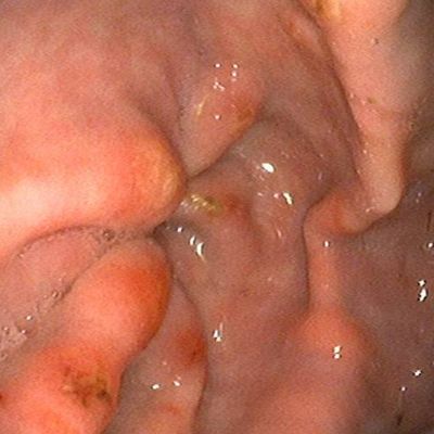Gastric ulcer in a horse